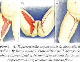 Dermolipectomia Crural