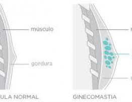 Ginecomastia