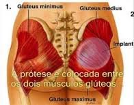 Gluteoplastia